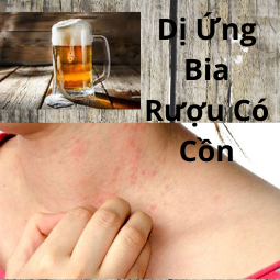 Dị Ứng Bia Rượu Có Cồn 